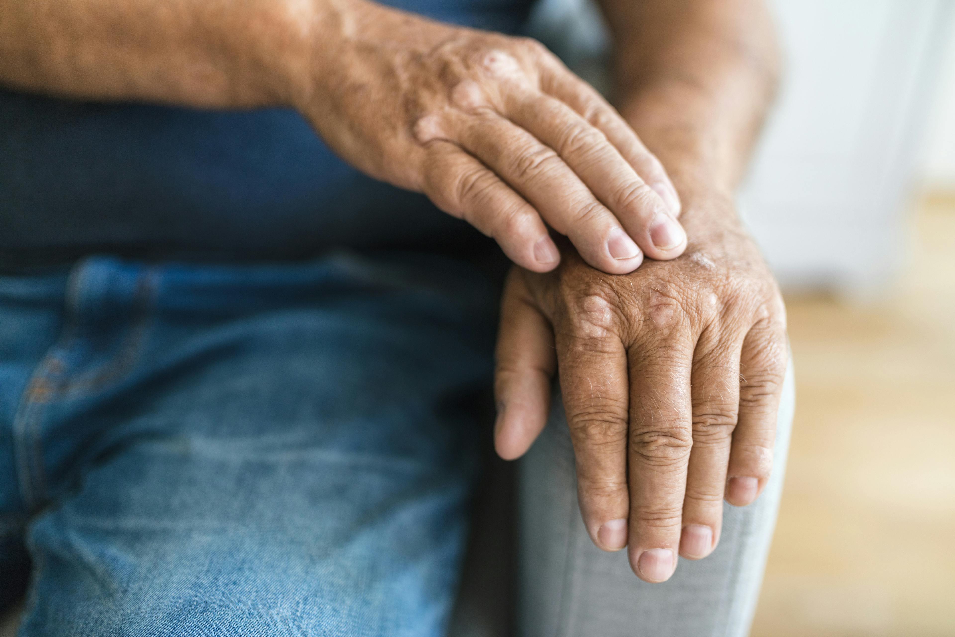 managing psoriatic arthritis hands