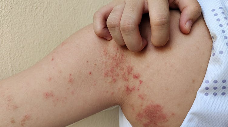 rash on shoulder and autoimmunity triggers